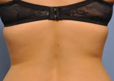 Back view of woman showing bra fat area before treatment.