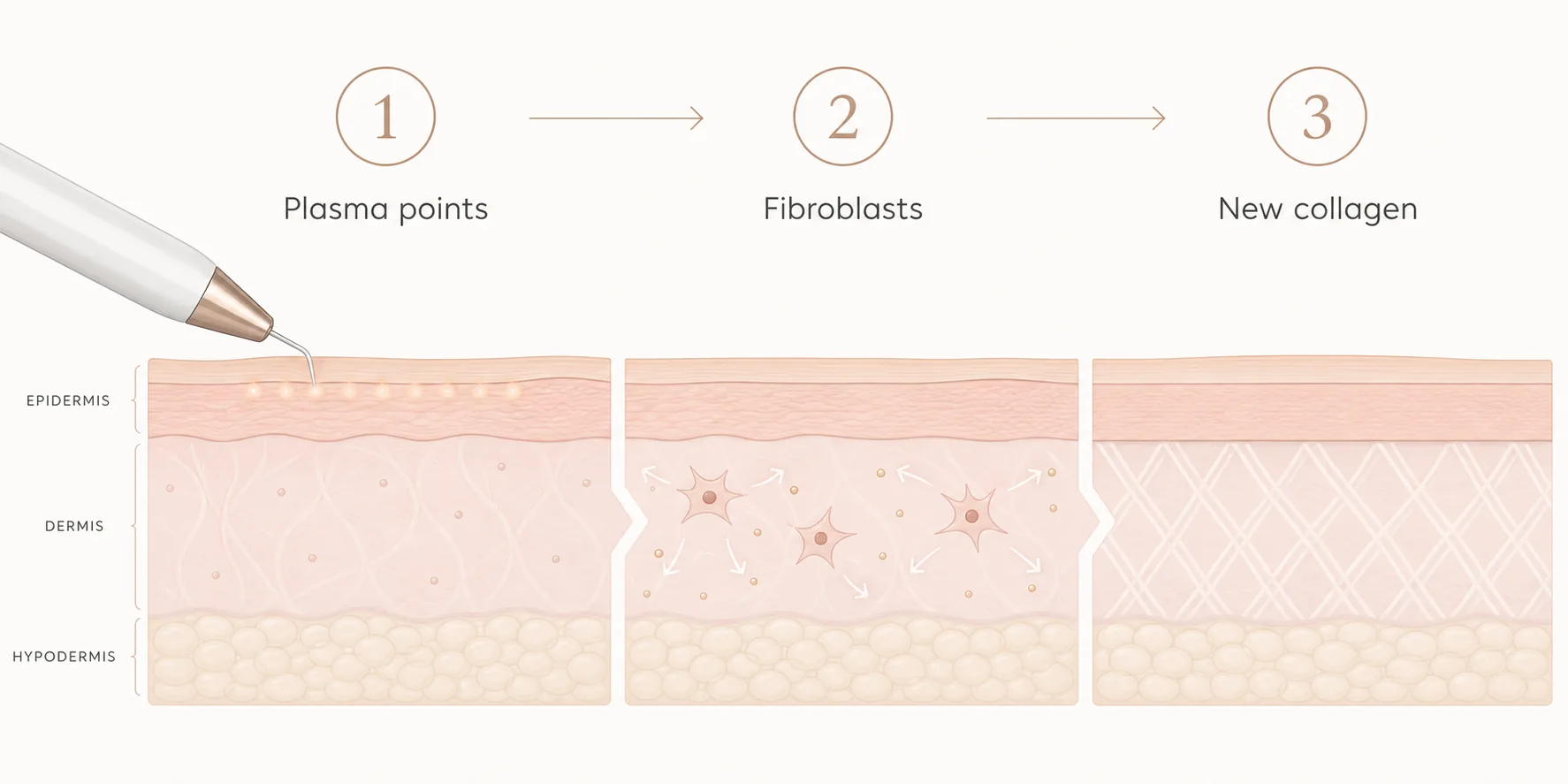 Three-step diagram of the plasma pen stimulating fibroblasts and collagen to tighten forehead skin