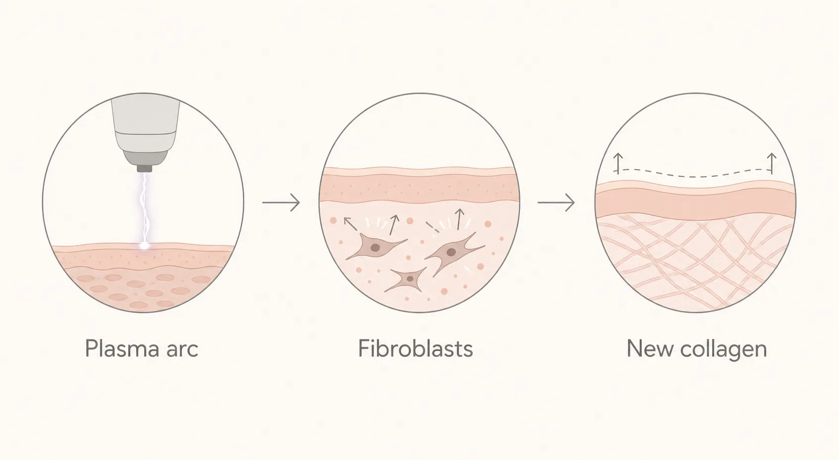 Diagram showing how a plasma pen arc activates fibroblasts to produce new collagen for firmer skin