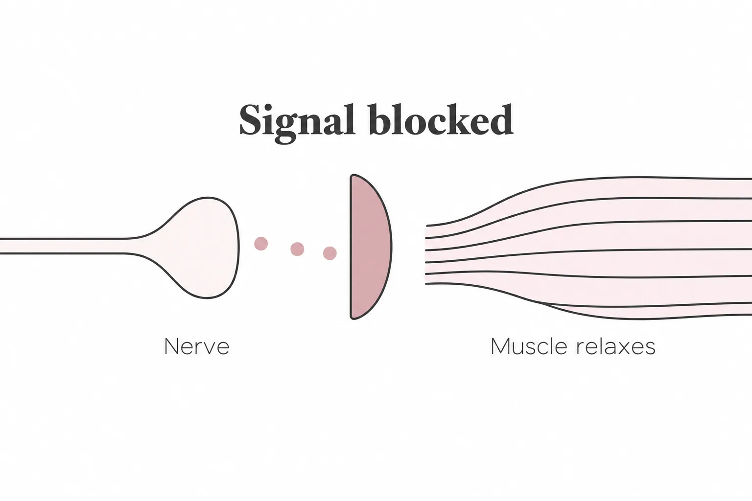 Diagram of a nerve ending sending signals toward a facial muscle, with the signal blocked at the junction so the muscle relaxes