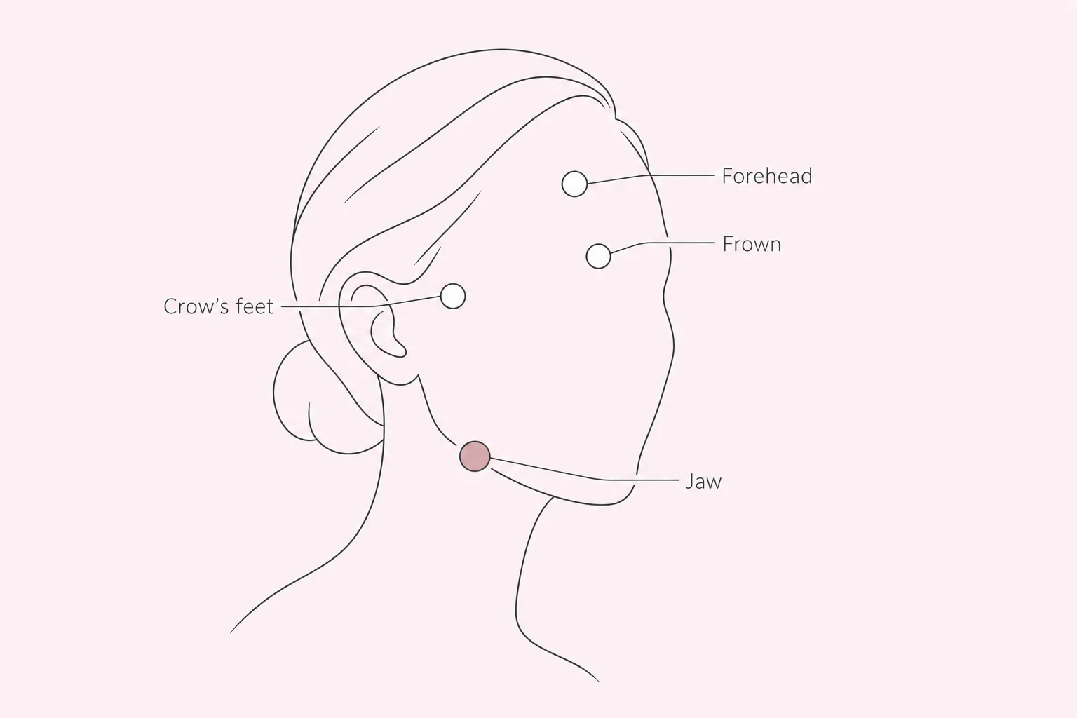 Minimal line-art face map marking common Botox treatment areas: forehead, frown lines, crow's feet and jaw, with the jaw highlighted