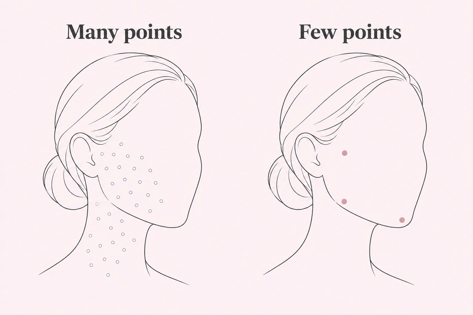 Side-by-side face outlines comparing skin booster micro-injections spread across the cheek and neck with a few targeted dermal filler points at the cheekbone, jaw and chin